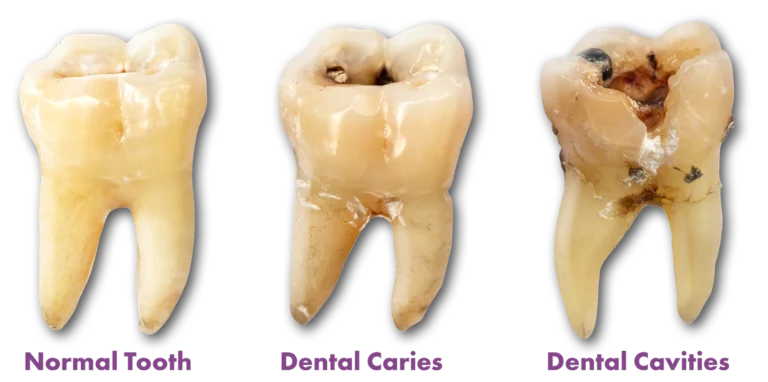 Comparison image showing a normal healthy tooth, early dental caries, and advanced dental cavities illustrating different stages of tooth decay.