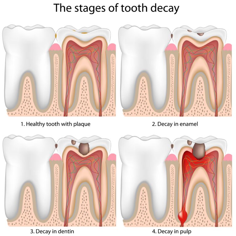 Diagram showing early signs of tooth decay including white spots, discoloration, and cavities on teeth.