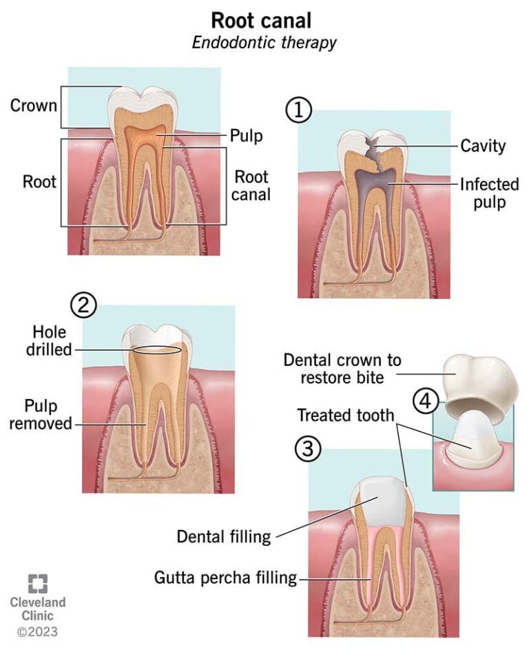 Ek diagram jo root canal procedure ke 4 mukhya steps ko dikhata hai: infection ka hona, pulp ko nikalna, gutta-percha bharna, aur ant mein dental crown lagana.