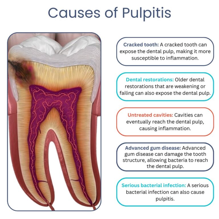 An educational infographic titled "Causes of Pulpitis" showing a cross-section of an inflamed tooth and listing five major causes: cracked teeth, failing dental restorations, untreated cavities, advanced gum disease, and bacterial infections.