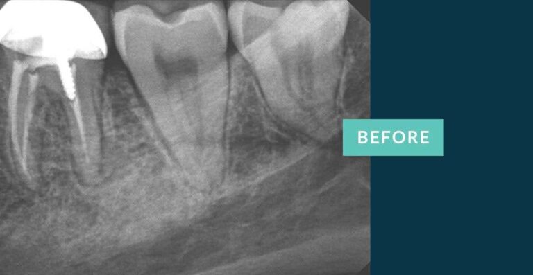 Infographic listing 5 causes of pulpitis: cracked teeth, failing restorations, cavities, gum disease, and infection.