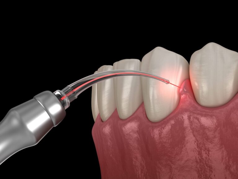 Close-up illustration of dental laser treatment targeting infected gums around teeth using advanced laser dentistry technique