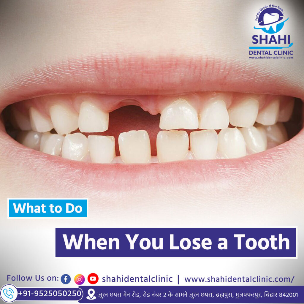 Close up of a person's smile with a missing upper front tooth, illustrating what to do when you lose a tooth.