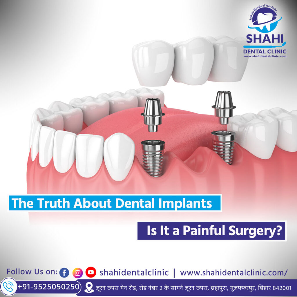 3D dental animation showing the components of a dental implant procedure, including the post, abutment, and crown.