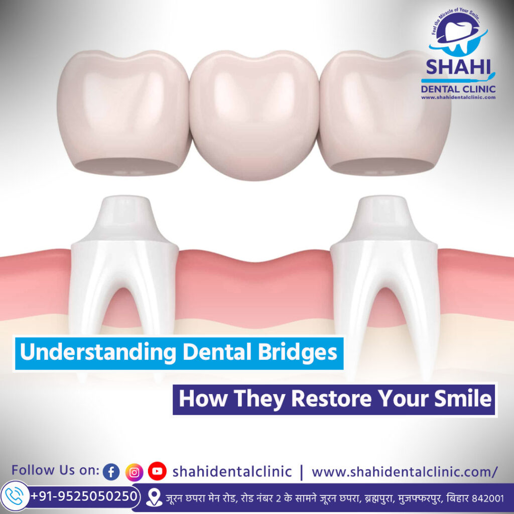 3D illustration showing a three-unit dental bridge being placed over two prepared natural anchor teeth to replace a missing tooth in the middle.