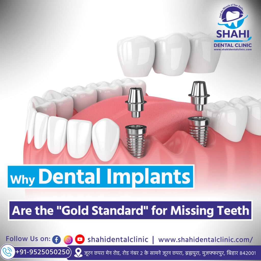 3D dental illustration showing titanium implant posts embedded in the jawbone supporting a ceramic bridge to replace missing teeth.