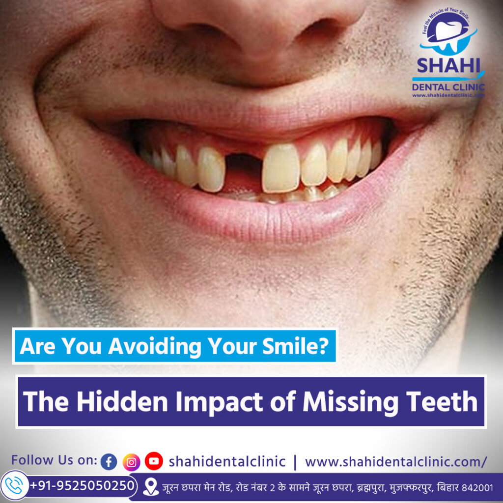 Close-up of a smiling man with a visible missing upper front tooth, illustrating the aesthetic and psychological impact of tooth loss.