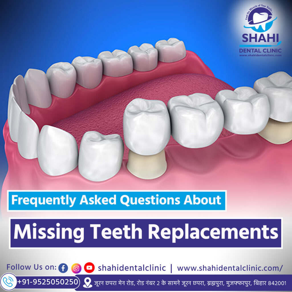 3D dental illustration of a lower jaw showing a dental bridge fitting over a prepared tooth, highlighting missing teeth replacement options.